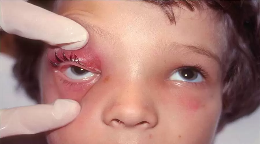 تومور چشم کودکان